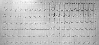 Spontaneous coronary artery dissection and atherosclerosis in a young man with systemic lupus erythematosus: A case report and literature review